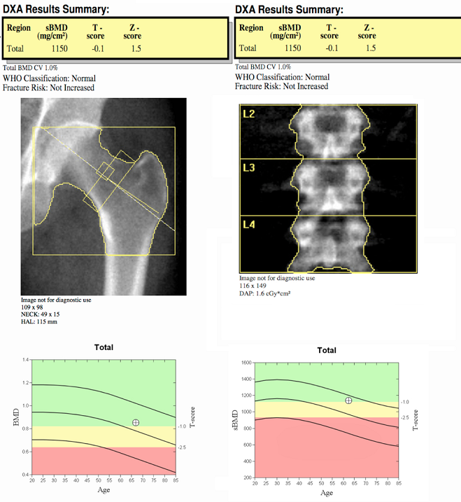 DEXA exam summary